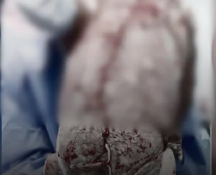 Bebê nasce com Diu colado ao corpo e caso viraliza nas redes