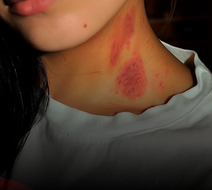 Com marcas no pescoço, esposa diz ter sido atacada por lobisomem em Goianinha (RN)