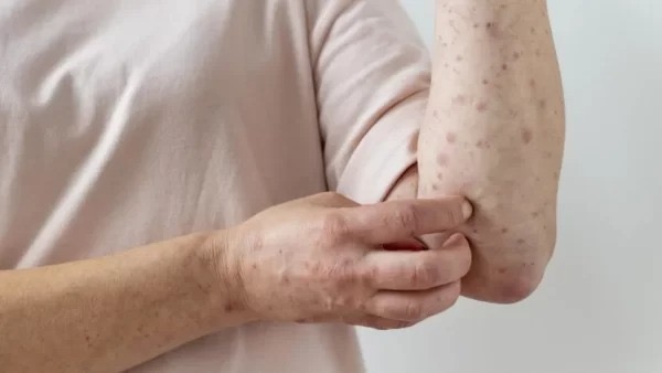 Exames descartam mpox em paciente atendido em Mossoró